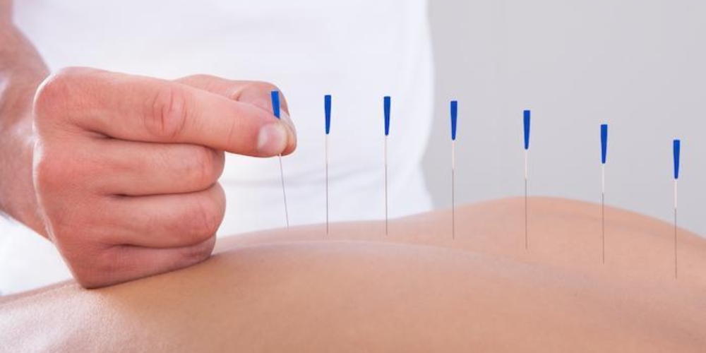 Dry Needling Treatment Service in Kompally, Hyderabad