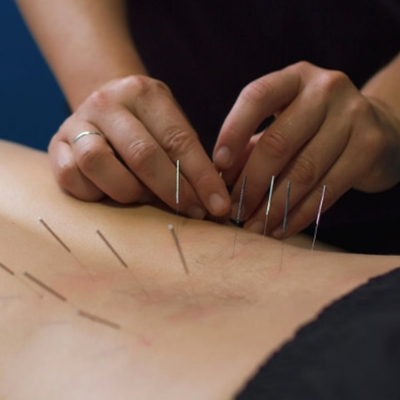 Dry Needling Therapy in Kompally, Hyderabad